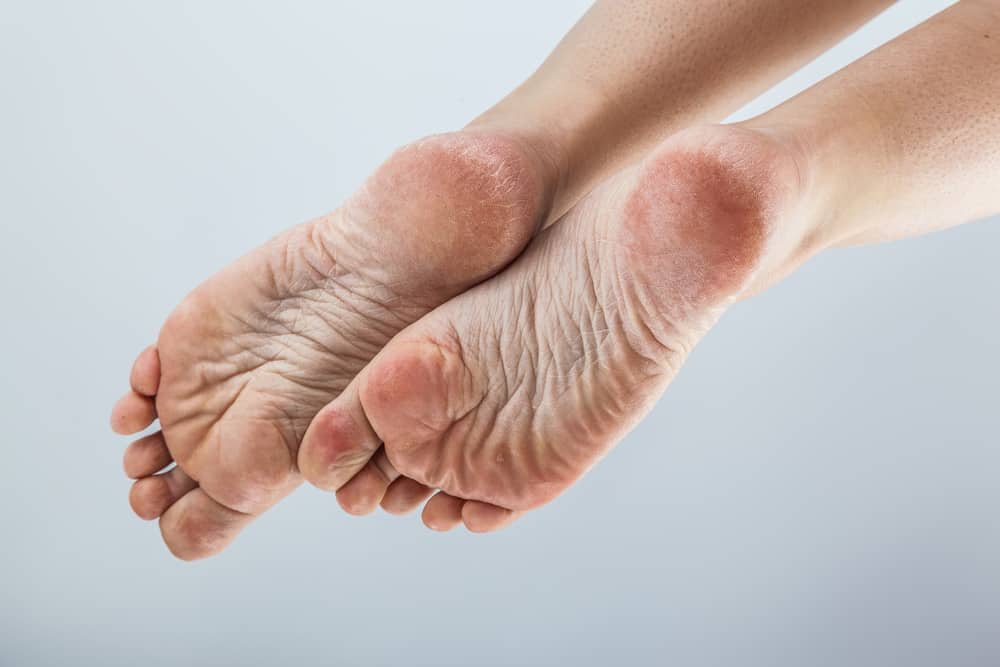 Can Diabetes Cause Foot Calluses