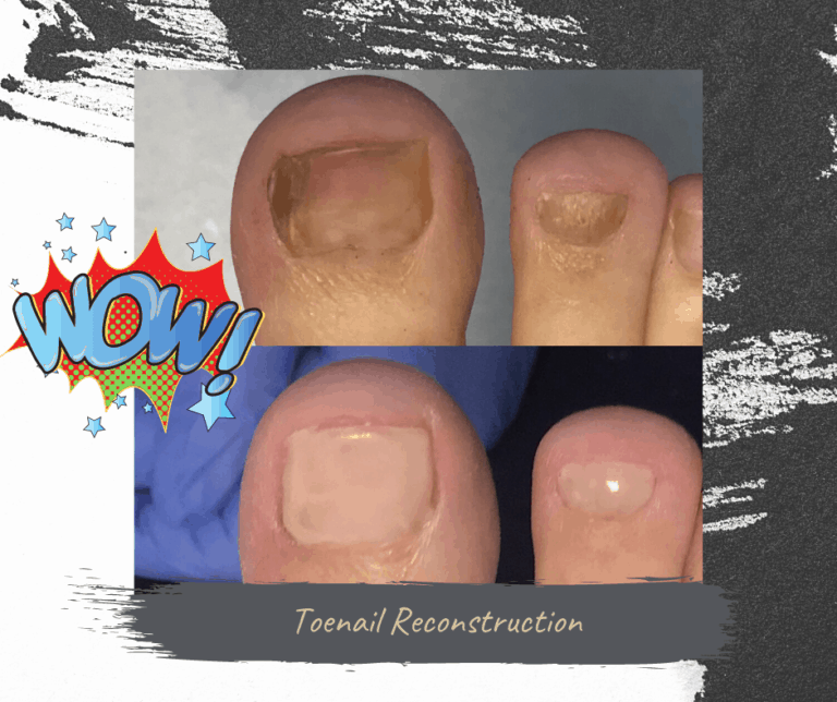 Toenail Reconstruction Is The Answer For Damaged Toenails Walk This