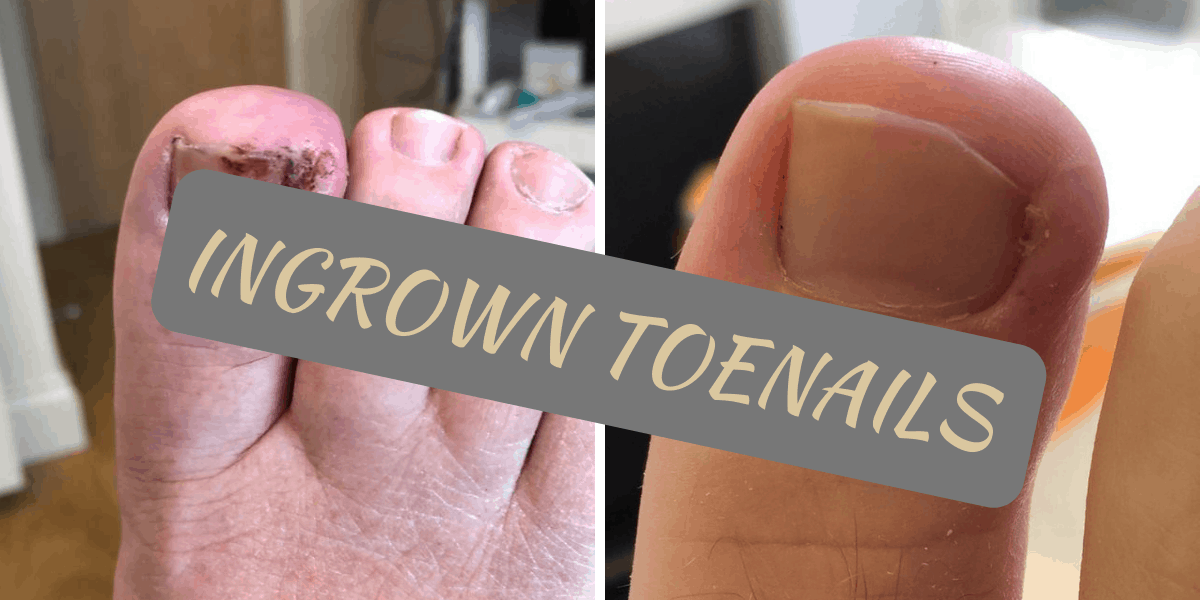 Ingrown Toenails Treatment Walk This Way Healthcare