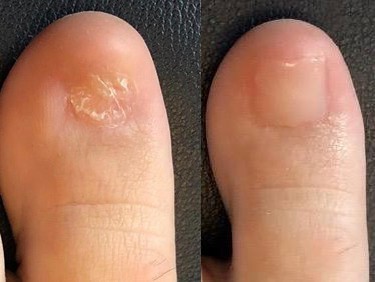 Cosmetic Gel For Toenails | Walk This Way Podiatry