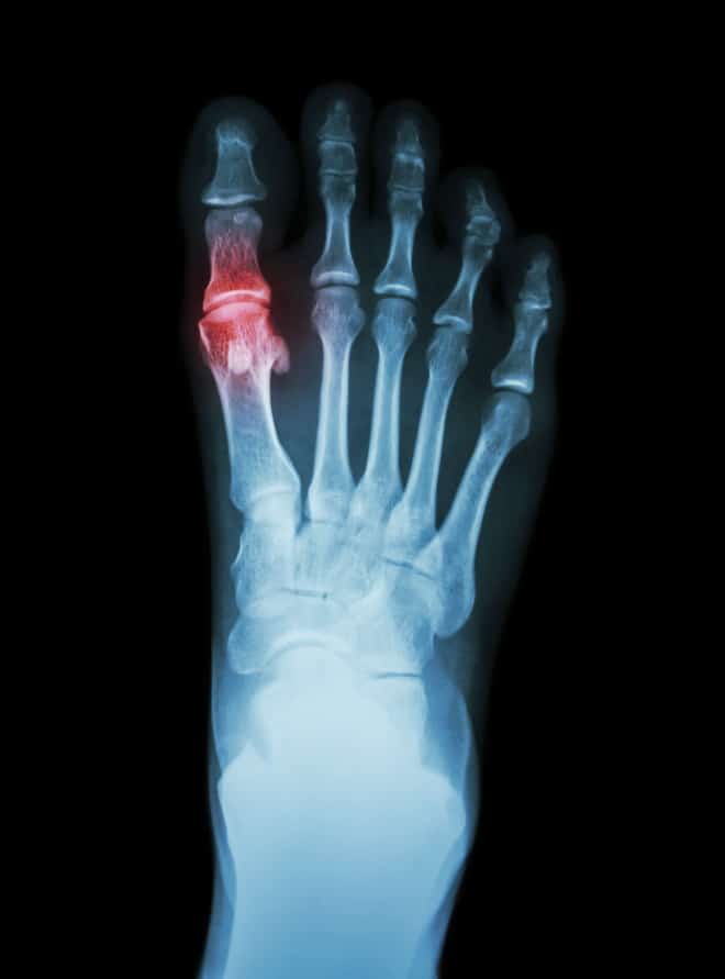 Arthritic Feet | Walk This Way Podiatry